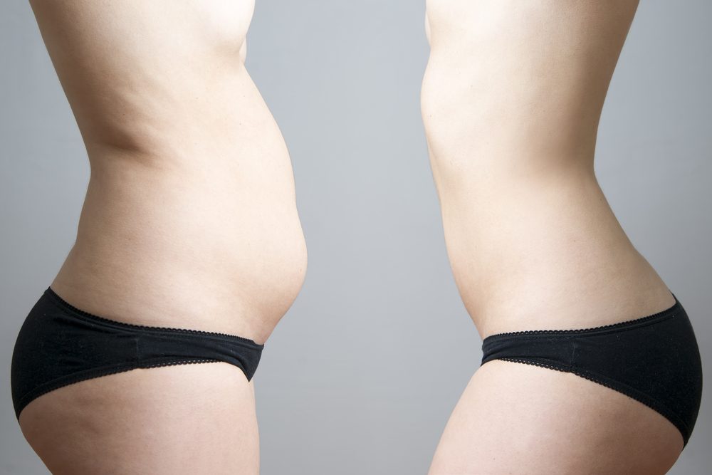 Gaine après abdominoplastie - Culotte haute pour liposuccion ventre 
